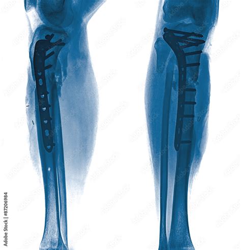 Film Leg Aplateral Show Fracture Shaft Of Tibia And Fibular Legs
