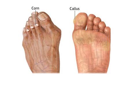 When you are healthy, you should only require treatment for calluses when they cause any. callus-corn - Podiatry First