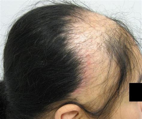 Traction Alopecia Treatment Pictures Photos