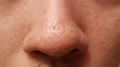 Scarred Pores On Nose Joining Togetherat A Loss Scar Treatments