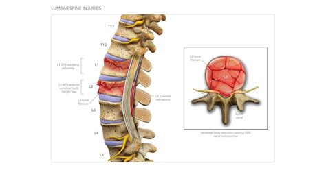 One major difference is that t12 vertebrae has facet for attachment of 12th ribs (if present, many people have only 11 ribs) and l1 don't have. L1 L2 Lumbar Spine Injuries | High Impact® Visual ...