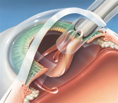 Day Of Cataract Surgery Eye Care Ltd Ophthalmologists Eye Surgeons