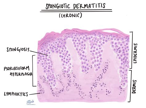 Spongiotic Dermatitis Mypathologyreportca