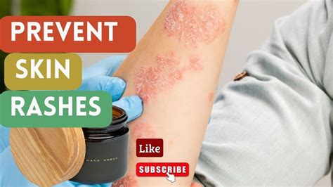 Dealing With Skin Rashes Causes Treatment And Prevention Youtube