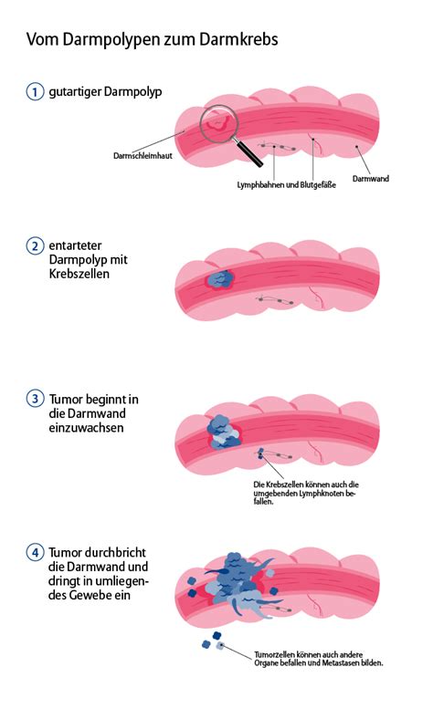 Darmkrebsvorsorge Darum Ist Sie So Wichtig Allianz Gesundheitswelt