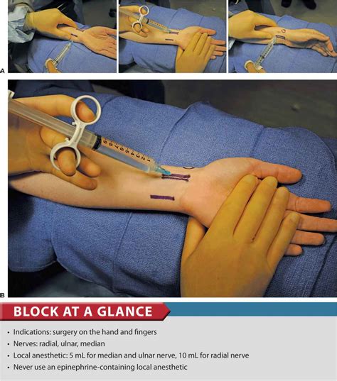 Wrist Block Anesthesia Key