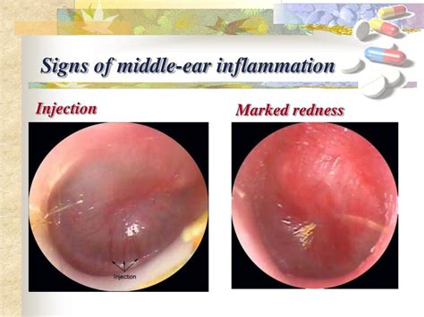 Ppt Acute Otitis Media Powerpoint Presentation Free Download Id