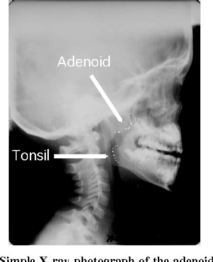 Figure 2 From Vicissitude Of Curetted Adenoid Vegetations Semantic