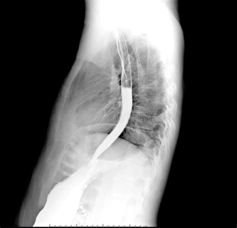 Esophagram Or Barium Swallow Lateral View Stock Photo Image Of