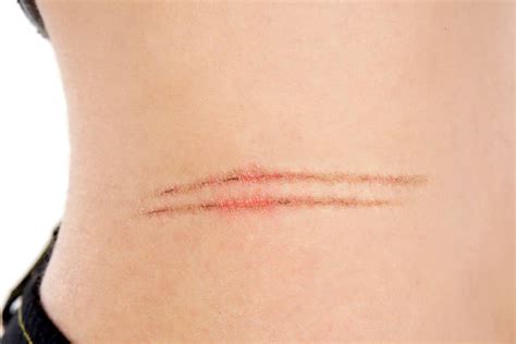 Skin Scratch Marks