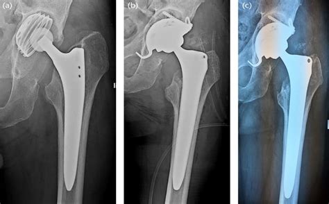 A 66 Year Old Male Who Sustained A Femoral Neck Fracture Treated With