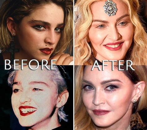 Madonna Before And After Plastic Surgery Madonna Celebrity Plastic