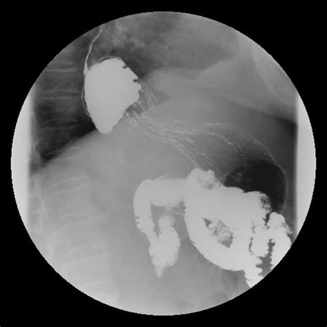 Esofagografia Sliding Hiatus Hernia Upper Gi Study Confirm The