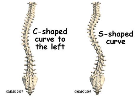 What Is Scoliosis A Comprehensive Overview