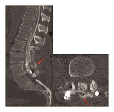 Sagittal And Axial Ct Lumbar Myelogram Images Show A Focal Csf Leak