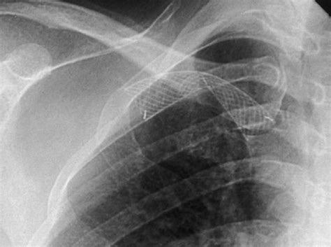 Comparison Of Open Cell Stent And Closed Cell Stent For Treatment Of Central Vein Stenosis Or