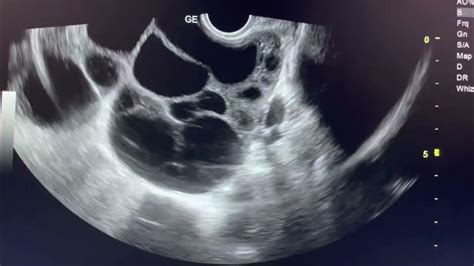 Ovarian Hyperstimulation Syndrome Ultrasound Ovariancyst Sonography