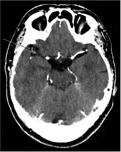 Ct Angiogram Of The Brain Showing Reduced Contrast Within The Right M1