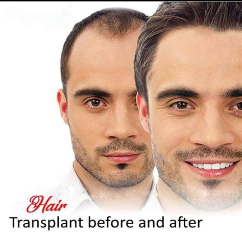 Hair Transplant Lasers Skin And Cosmetic Surgery 24 × 7 Daltonganj