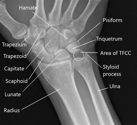 Wrist Anatomy Mri Wrist Axial Anatomy Free Cross Sect Vrogue Co