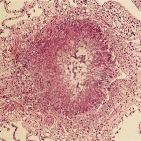 Spectrum Of Pulmonary Aspergillosis Histologic Clinical And