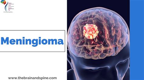 Meningioma Symptoms Causes And Treatment Best Neurosurgeon In Uttar