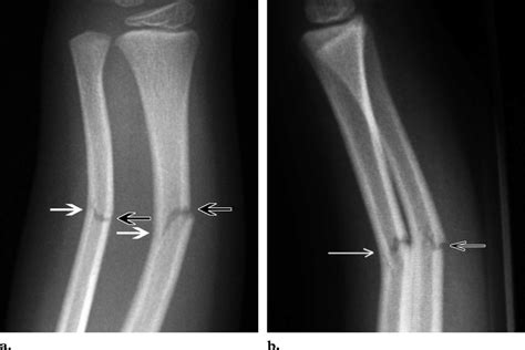 Greenstick Fracture X Ray