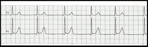 Float Nurse: Practice EKG Rhythm Strips 163