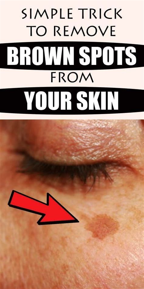Simple Trick To Remove Brown Spots From Your Skin Medicine Health Life