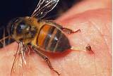 Pictures of First Aid For Wasp Sting