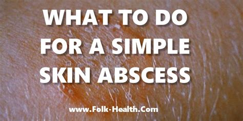 Simple Skin Abscess Treatment Folk Health 2023