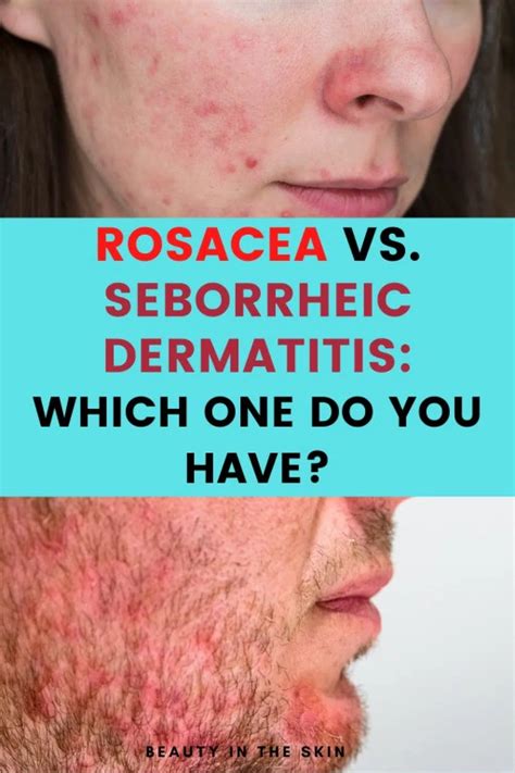 Rosacea Vs Seborrheic Dermatitis How To Tell The Difference Beauty