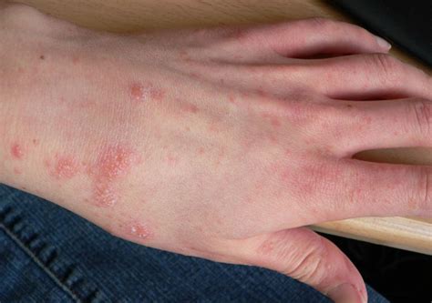 Scabies Home Remedies That Helped Many People Before You