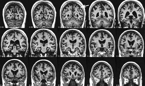 Amnestic Mild Cognitive Impairment Structural Mr Imaging Findings