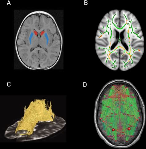 Diffusion Imaging In Huntingtons Disease Comprehensive Review