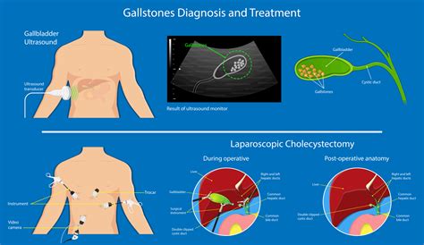Cholecystectomy Or Gallbladder Removal Cost To Go Private The Best