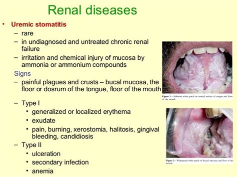 Oral Manifestations Of Systemic Diseases