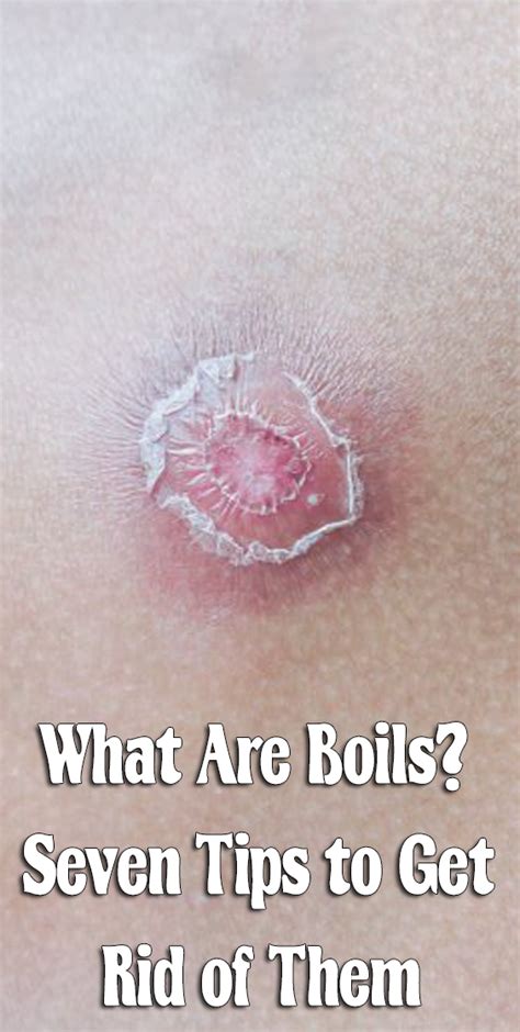 What Are Boils Seven Tips To Get Rid Of Them Get Rid Of Boils
