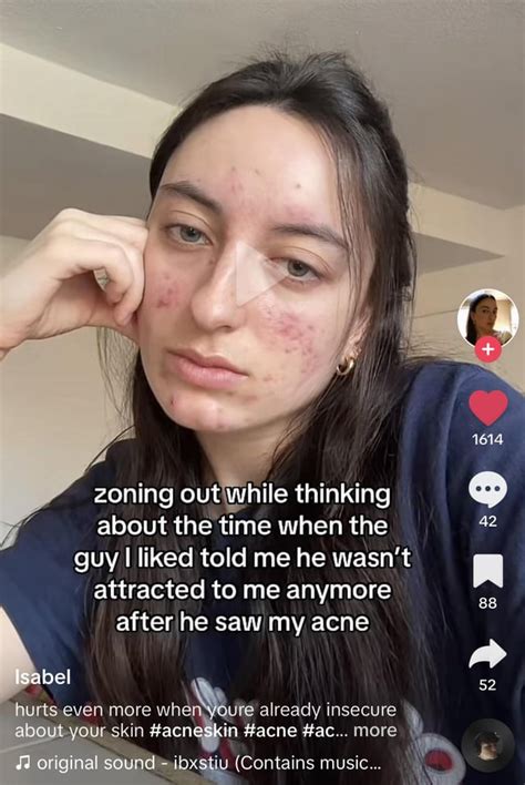 does anyone else have a fear of dating meeting new people bc of acne u stock party 2450