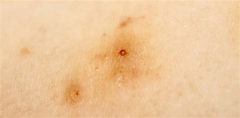 Molluscum Contagiosum Symptoms Causes Treatments Clear Skin Clinic