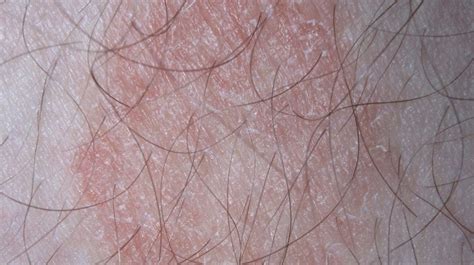 Pictures Of Different Skin Disorders Ailynne Vergara Wijangco Dermatology
