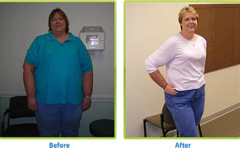 Before And After Weight Loss Surgery Licensed Under A Crea Flickr
