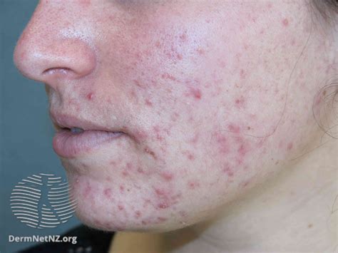 Descripción general de los tipos y etapas del acné Medicina Básica