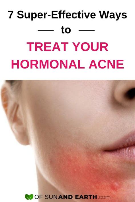 7 Super Effective Ways To Treat Your Hormonal Acne Hormonal Acne