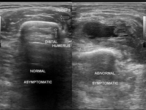 Partial Rupture Of Triceps Muscle Image Radiopaedia Org