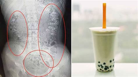 But they are competitively priced with their competitors in ss 15! Girl's Viral X-ray Shows Undigested Bubble Tea Pearls That ...