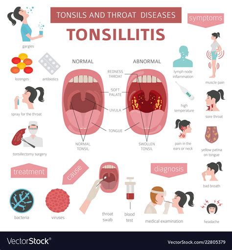 Tonsils And Throat Diseases Tonsillitis Symptoms Vector Image