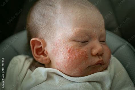 A Newborn Baby Suffering From Baby Acne Cradle Cap And Eczema On The