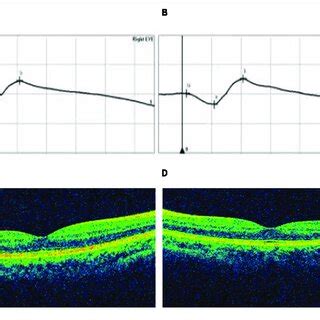 Optical Coherence Tomography OCT And Electroretinogram ERG Download Scientific Diagram