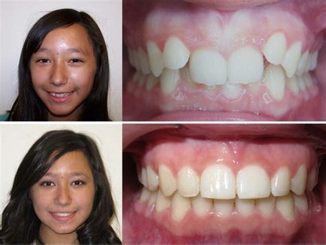 We did not find results for: Can Invisalign Fix Overbites and Other Bite Problems ...